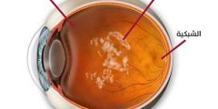 علاج الذبابة الطائرة في العين Eye Floaters