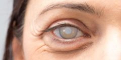 علاج المياه البيضاء cataract surgery