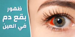 اسباب البقع الحمراء في العين eye doctor near me