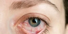 اسباب التهاب العنبية uveitis