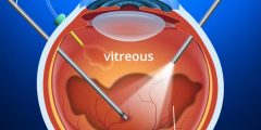 علاج انفصال الشبكية retinal detachment treatment