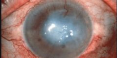 التهاب القرنية الشوكميبي keratitis sicca